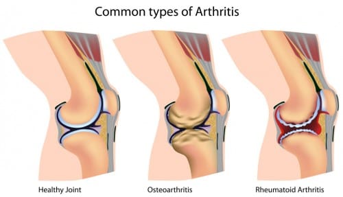 types of knee pain knee pain therapy malaysia