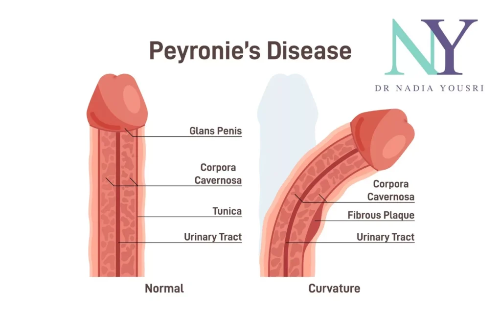 what is Peyronie's Disease malaysia