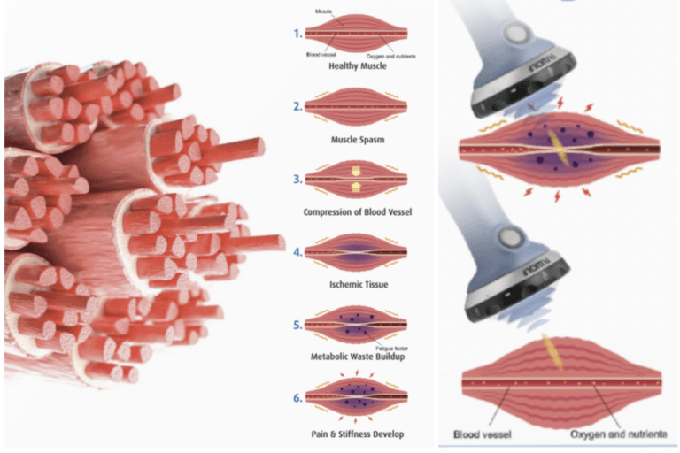 what is shockwave therapy malaysia