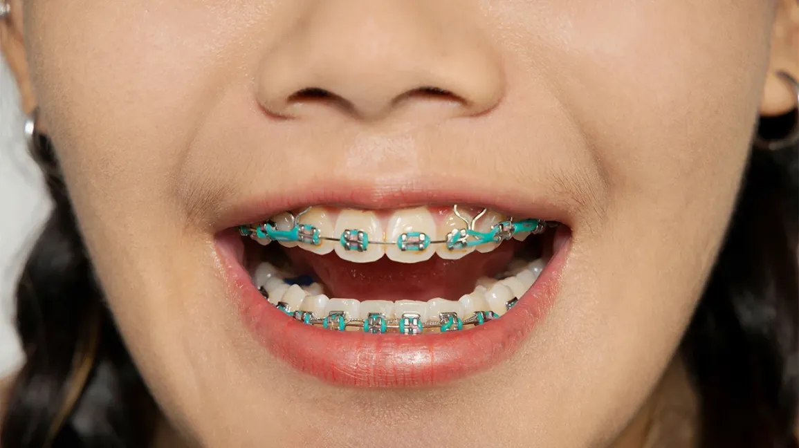 a close up of a person's mouth with braces