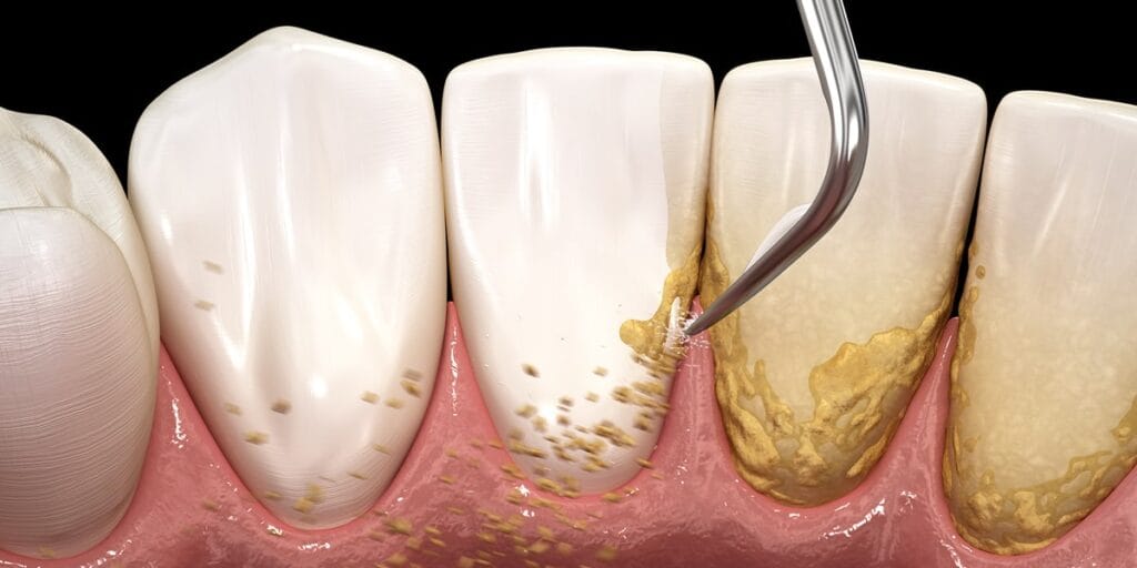 close-up of teeth and gums