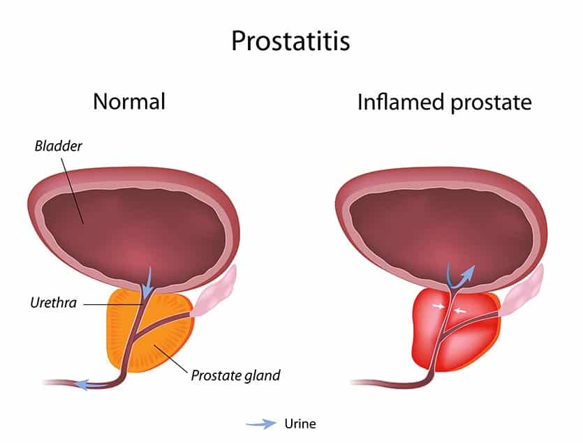 a diagram of prostatitis