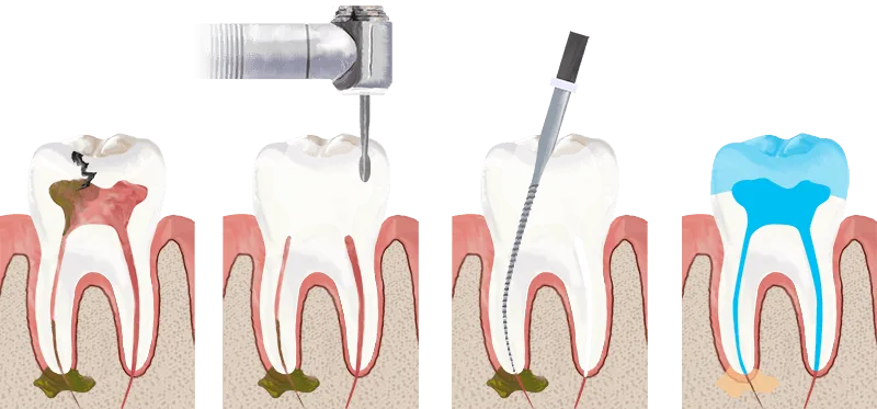 a close-up of a dental drill