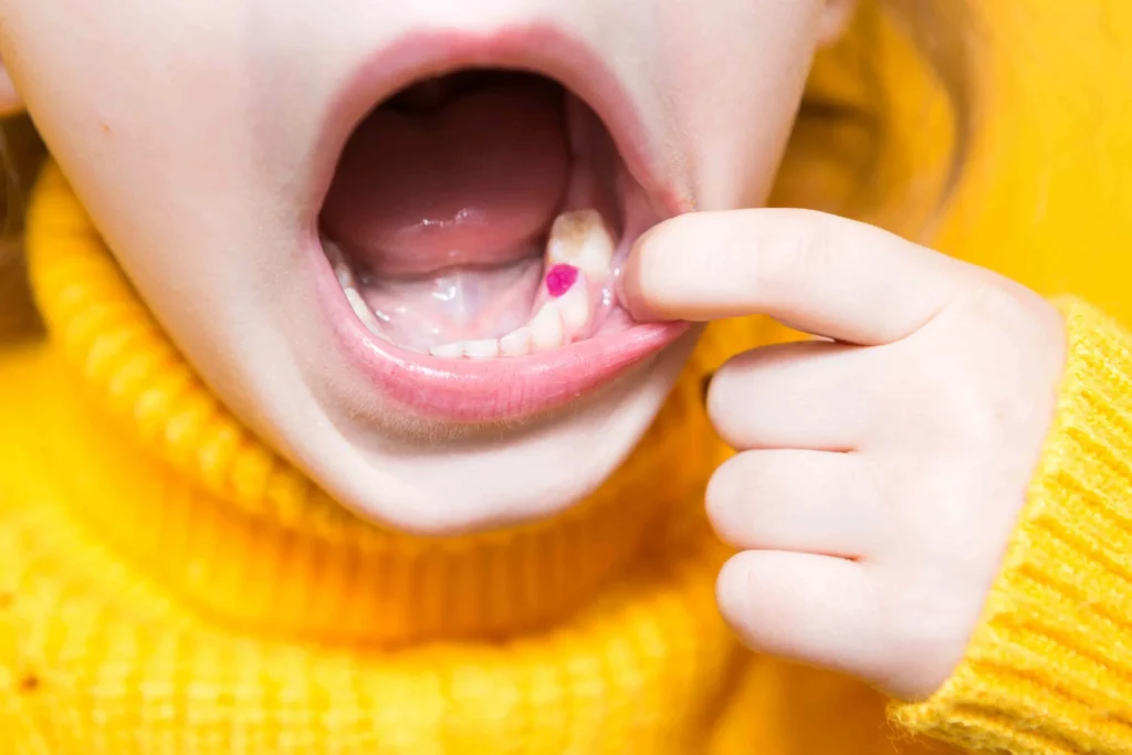 Dental Fillings in Bandar Sri Permaisuri scaled.jpg