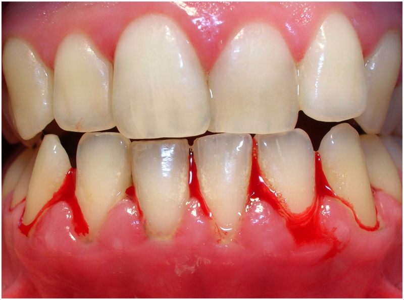 Close-up of a tooth with blood, indicating potential dental injury or gum disease