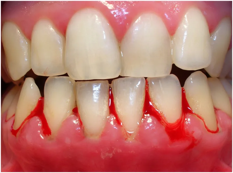 Close-up of a tooth with blood, indicating potential dental injury or gum disease